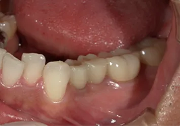 治療後写真 恵比寿南DENTAL