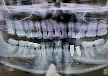 治療後写真 恵比寿南DENTAL