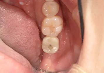 治療後写真 恵比寿南DENTAL