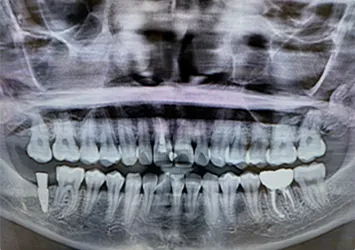 治療後写真 恵比寿南DENTAL