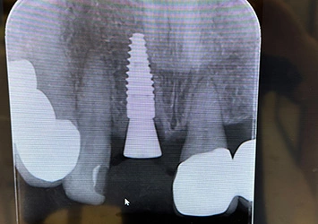治療後写真 恵比寿南DENTAL