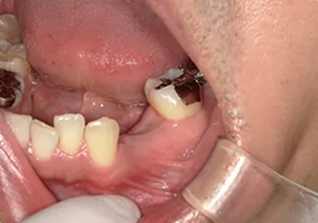 治療前写真 恵比寿南DENTAL