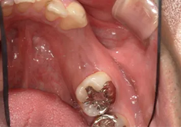 治療前写真 恵比寿南DENTAL