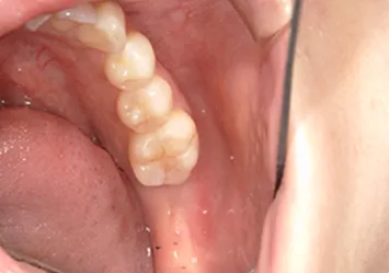 治療前写真 恵比寿南DENTAL