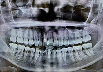 治療前写真 恵比寿南DENTAL