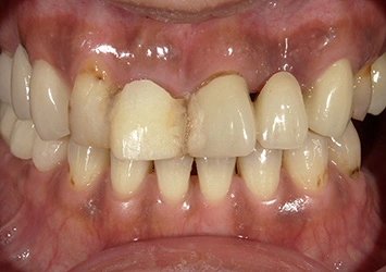 治療前写真 恵比寿南DENTAL