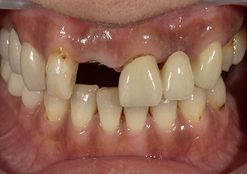 治療前写真 恵比寿南DENTAL