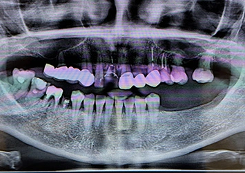 治療前写真 恵比寿南DENTAL