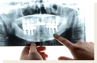 レントゲン写真 恵比寿南DENTAL