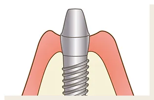 インプラントイラスト 恵比寿南DENTAL