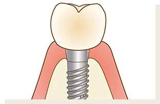 上部構造の装着イラスト 恵比寿南DENTAL