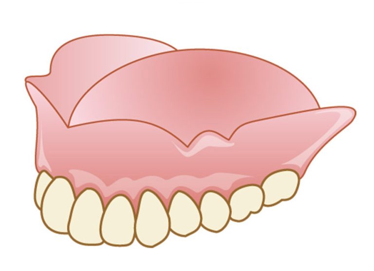 レジン床義歯（プラスチック義歯）