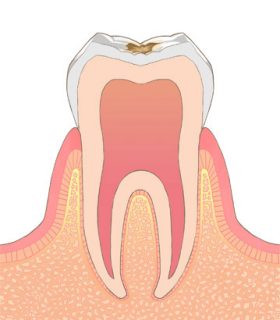 C1（歯の表面の浅い虫歯）