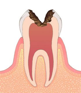 C3（神経まで進行した深い虫歯）