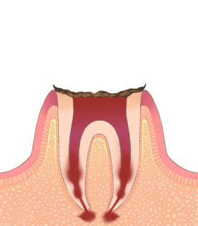C4（歯の根まで進行した虫歯）